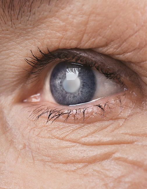 Cataract Surgery in Boise